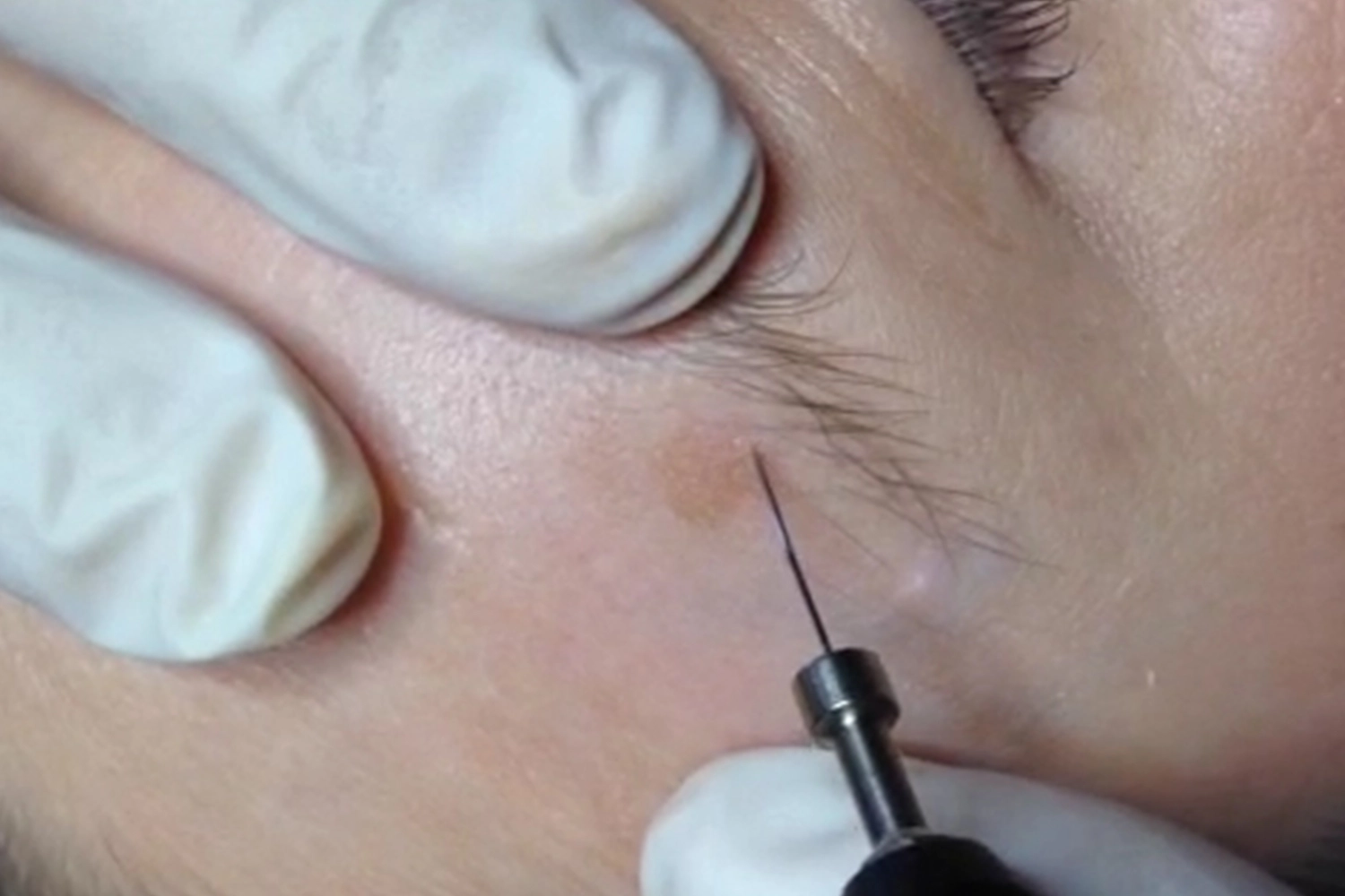 onetec® von Diotima Kosmetikinstitut