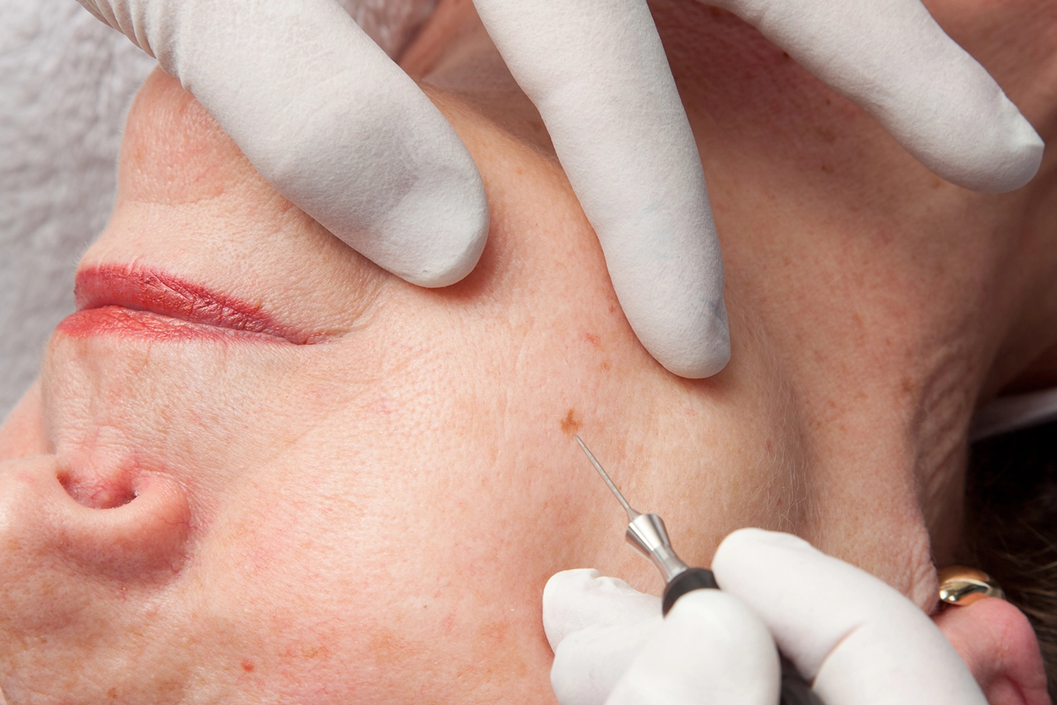 onetec® von Diotima Kosmetikinstitut