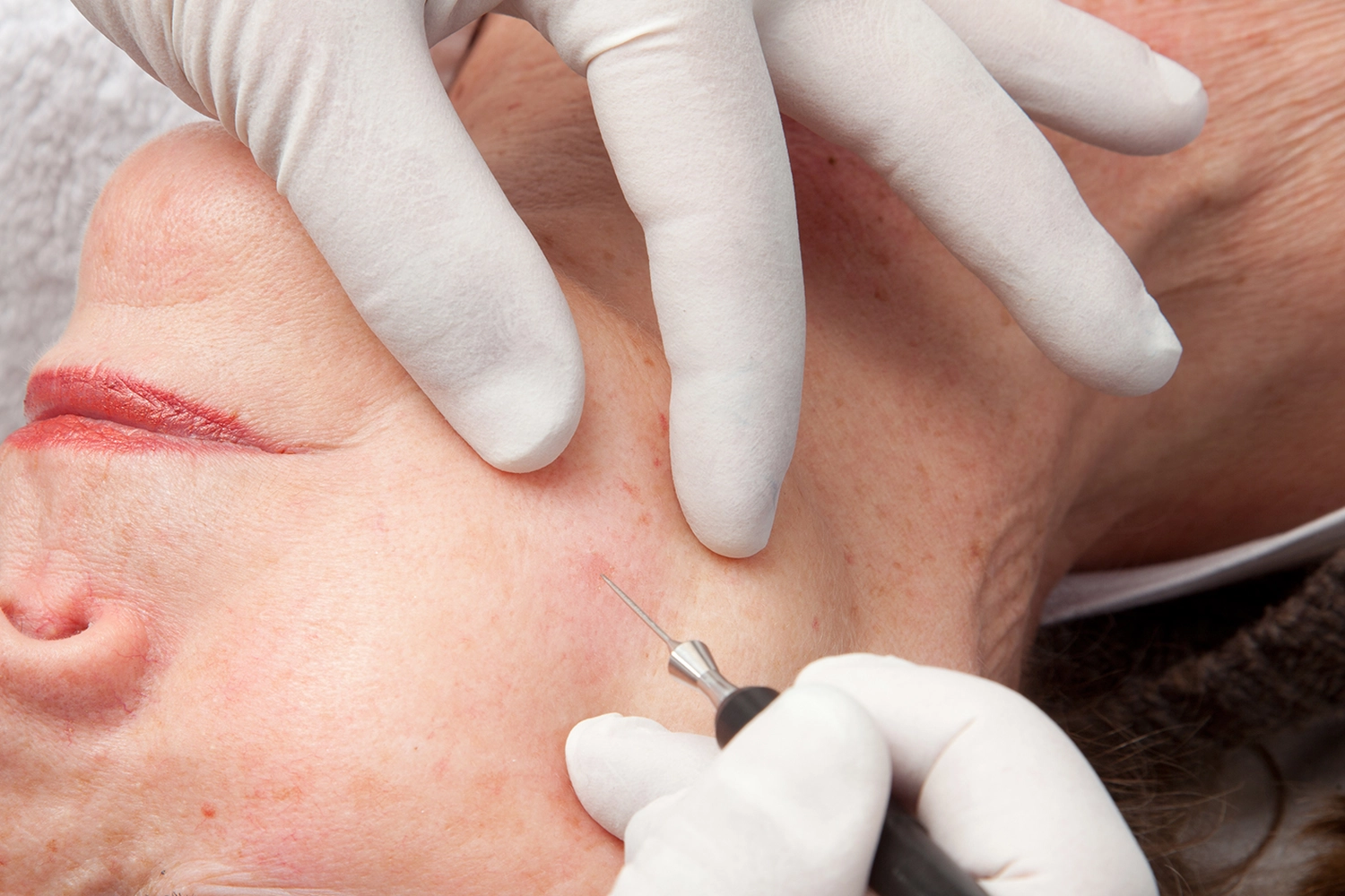 onetec® von Diotima Kosmetikinstitut